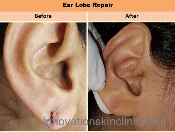 Ear-Lobe Repair 3